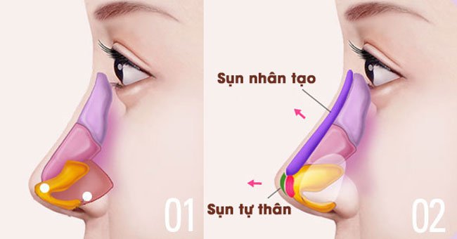 Các chuyên gia thẩm mỹ có thể kết hợp cả sụn nhân tạo và sụn tự thân