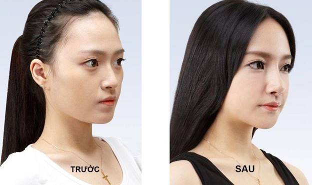 Ưu điểm và nhược điểm nâng mũi Softline 4D