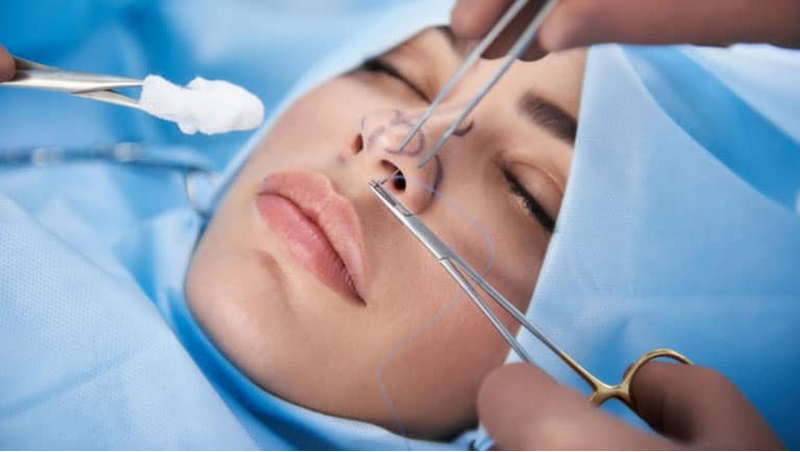 Quy trình thực hiện Nâng mũi Softline 4D