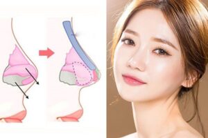 Nên nâng mũi bọc sụn hay cấu trúc