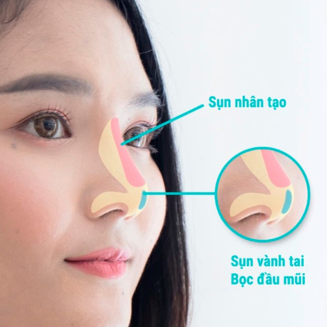 Nâng mũi bằng sụn nhân tạo giúp giải quyết vấn đề về kích thước và hình dáng của mũi